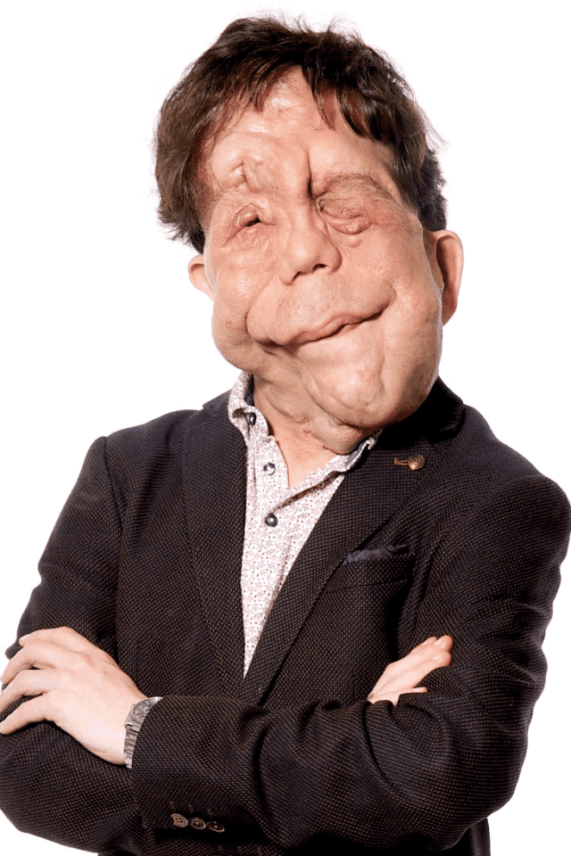 Adam Pearson disability rights speaker