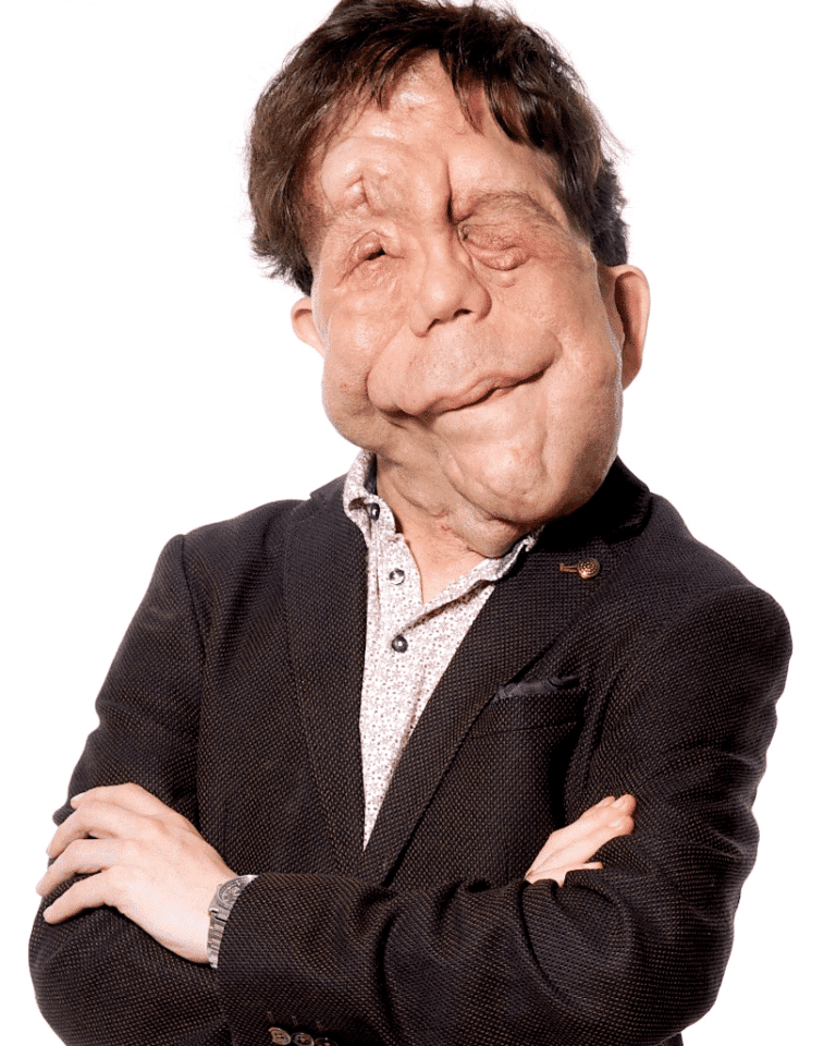 Adam Pearson disability rights speaker